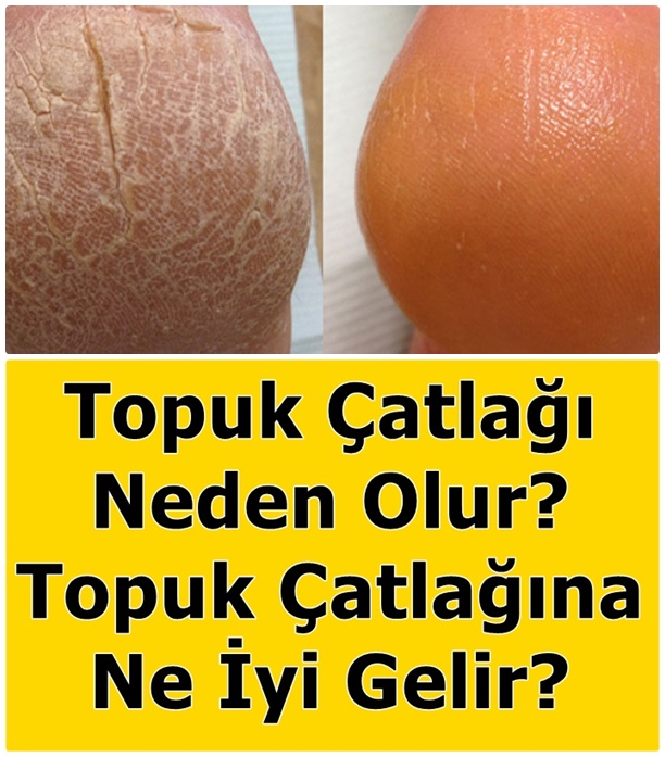 Topuk Çatlağı Neden Olur? Topuk Çatlağına Ne İyi Gelir?